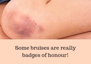 Some bruises are really badges of honour!